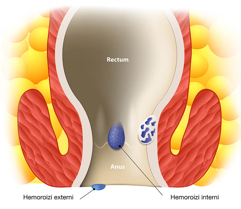 Schema grafica hemoroizi inteni si hemoroizi externi Schema grafica hemoroizi inteni si hemoroizi externi